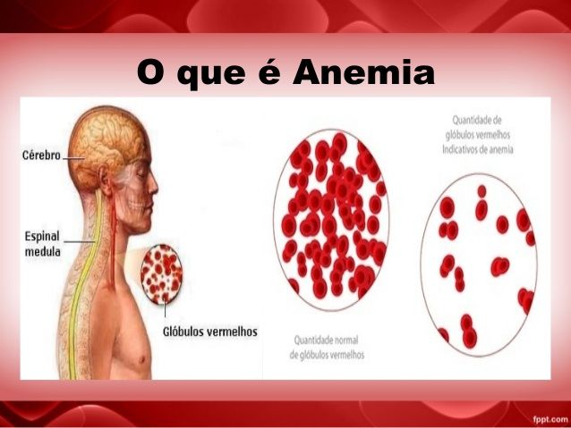 Anemia Como Prevenir E Tratar Através Da Alimentação 
